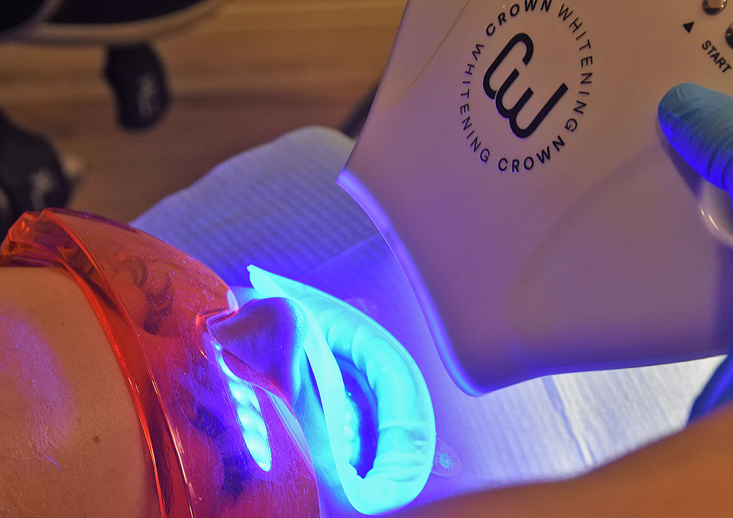 In-Office Crown Whitening Treatment with Consultation and Optional Whitening Kit at Green Dental (Up to 52% Off)