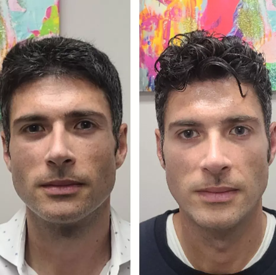 Lift and Tighten with Ultherapy Eye or Chin Treatment