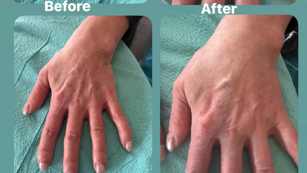 One Syringe of Radiesse for Neck / Décolleté and Hand Rejuvenation at No Pain All Gain Spa (Up to 30% Off)