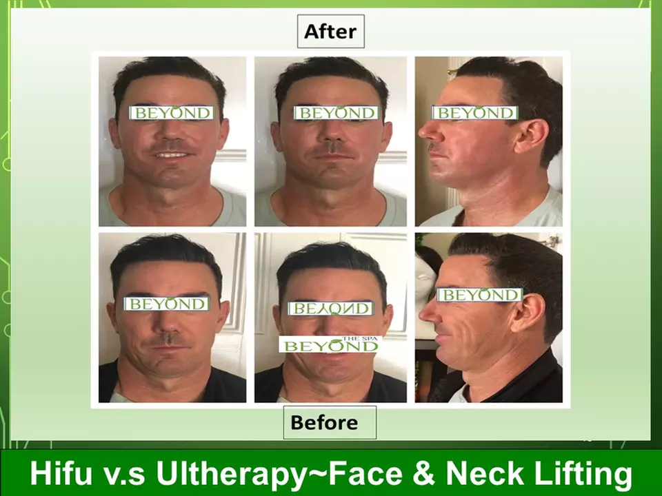 Lymphatic Drainage Massage with Hifu Options for Face and Body