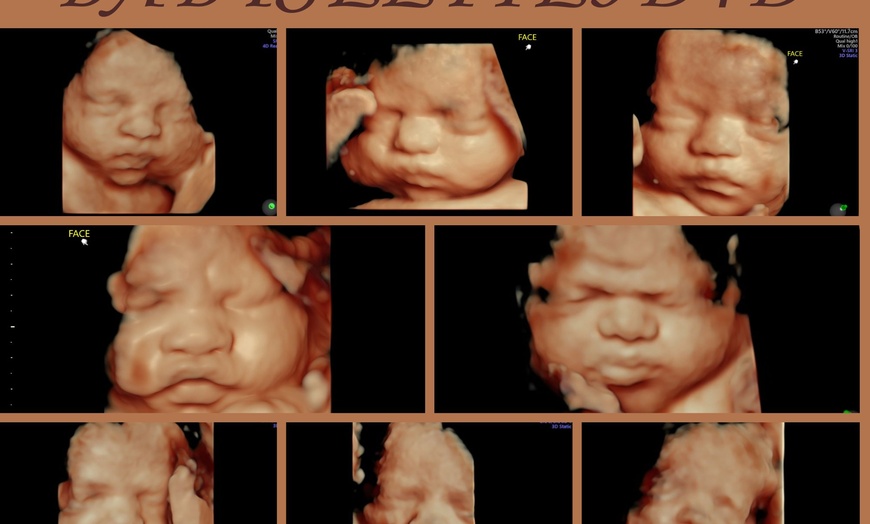 Image 1: Up to 30% Off on Ultrasound - 3D / 4D at BabySelfie