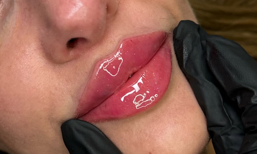 Image 2: Get 20, 40 Units of Xeomin Injections or One Russian Lip Filler