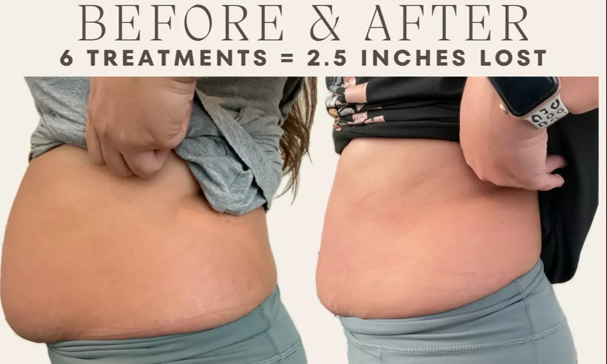Up to 90% Off on Fat Reduction - Non-Branded at Renew Contouring