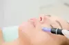 Discover Micro-Needling Treatments with Hyaluronic Acid or PRP Injections Up to 78%