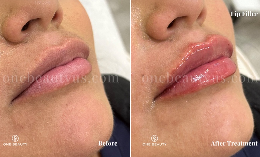 Image 3: Up to 52% Off on Injection - Dermal Filler at One Beauty Aesthetics