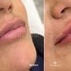 Image 3: Up to 52% Off on Injection - Dermal Filler at One Beauty Aesthetics