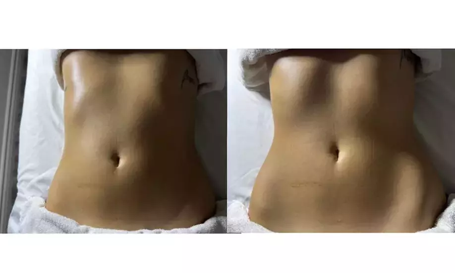 Experience One 45-Minute Lymphatic and Brazilian Body Shaping Combo