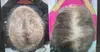 Revitalize Your Hair with PRP/PRF & Microneedling for Fuller Growth (Up to 70% Off) at Restorative Med Spa NYC