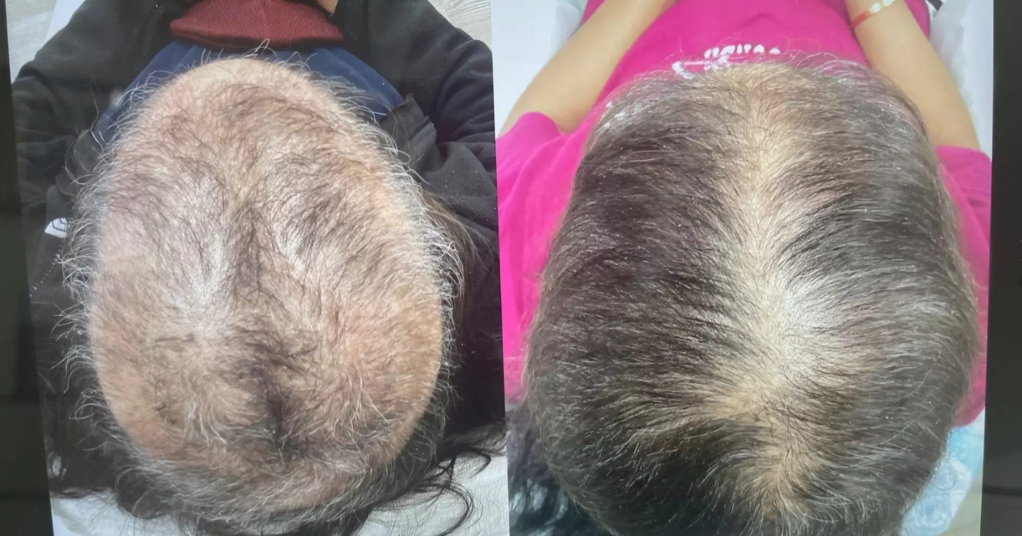Revitalize Your Hair with PRP/PRF & Microneedling for Fuller Growth (Up to 70% Off) at Restorative Med Spa NYC - Primary Image
