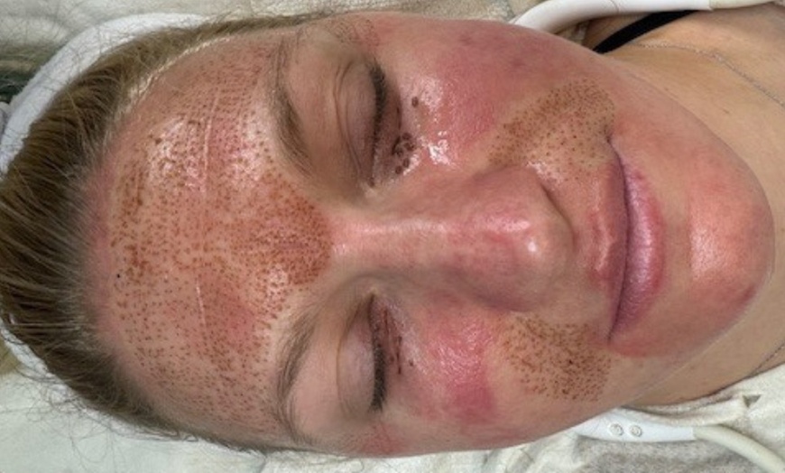 Image 1: Achieve Youthful Skin with Plasma Fibroblast Treatments