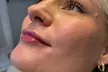 20, 40 or 60 Units of Botox or 1 ML Syringe Versa at Logica Aesthetics (Up to 35% Off) - Second Medium