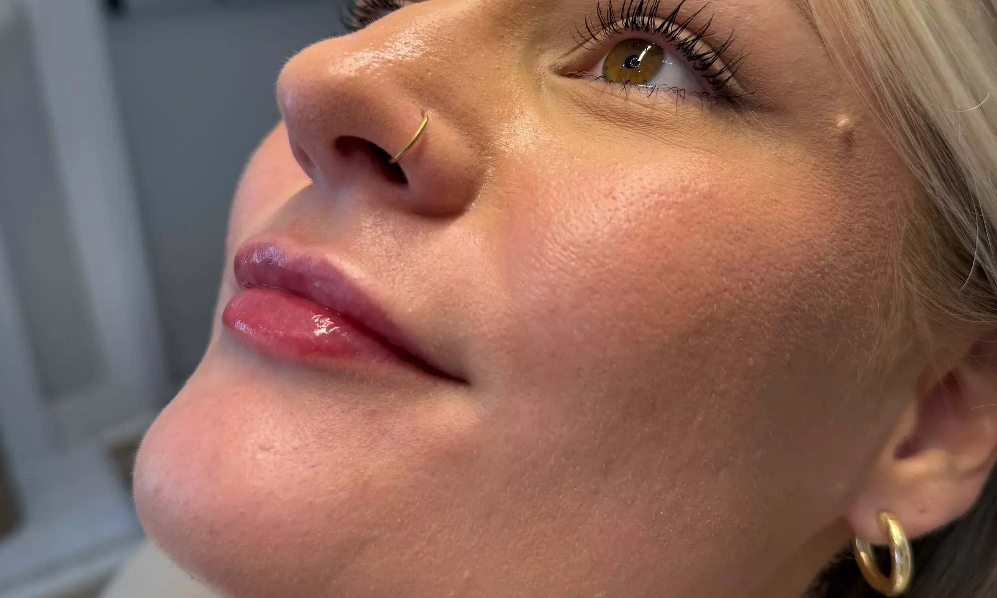 20, 40 or 60 Units of Botox or 1 ML Syringe Versa