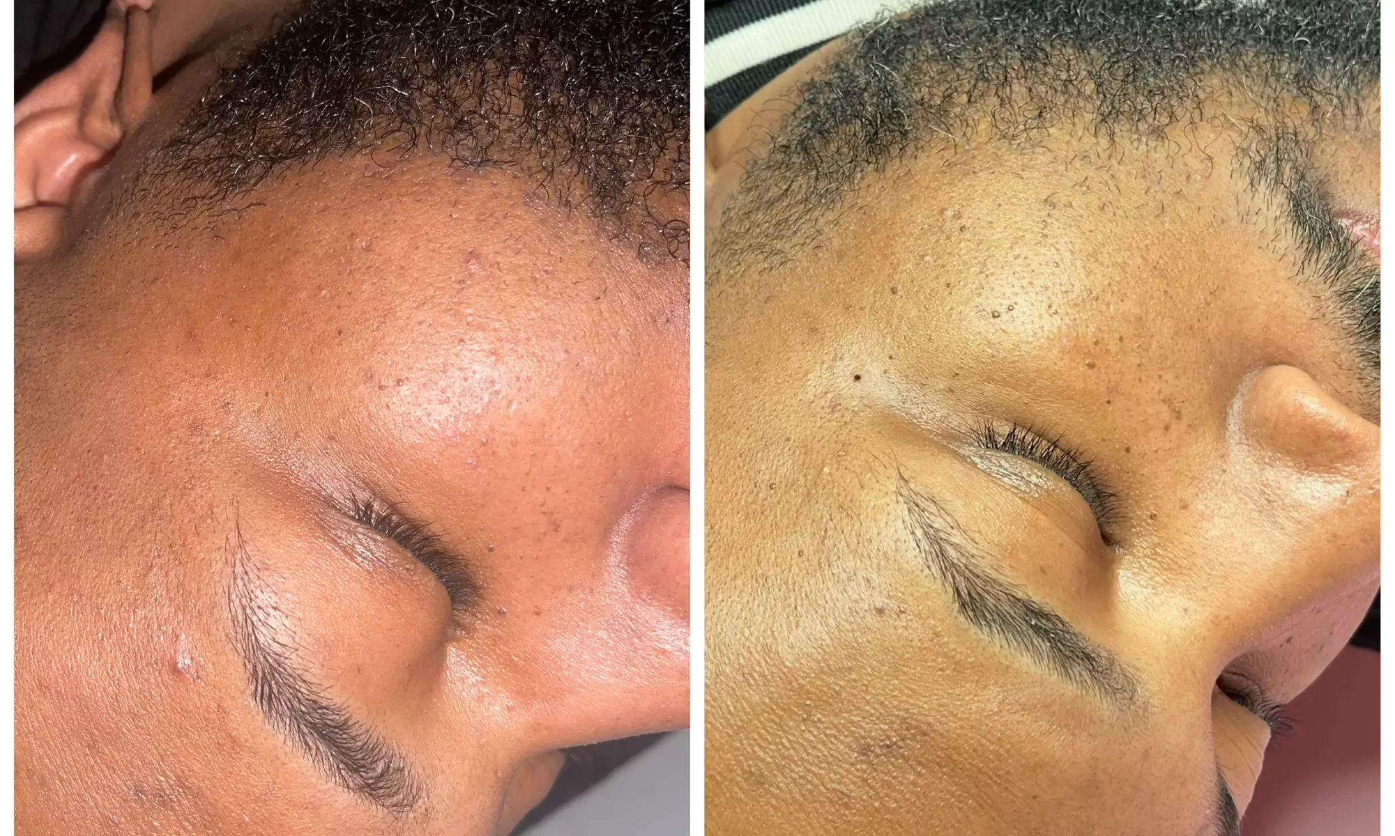 Experience Skin/Mole Removal for Face or Body at Clinical Complexions Llc (Up to 55% Off) - Primary Image