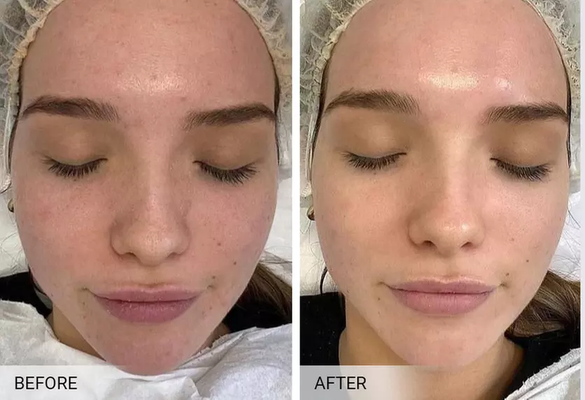 Up to 20% Off on Chemical Peel at Delray Med Spa