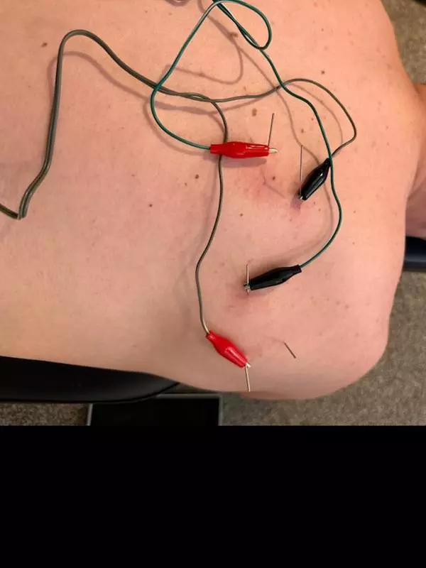 Chiropractic Exam and Adjustment with Dry Needling Options