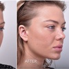 Image 8: Celebrity-Coveted Cheek Pop or Snatched Jawline with PDO Threads at No Pain All Gain Spa (Up to 30% Off)