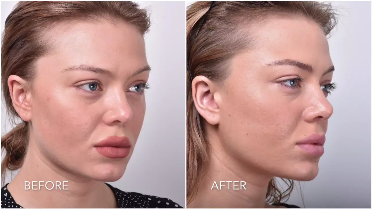 Celebrity-Coveted Cheek Pop or Snatched Jawline with PDO Threads