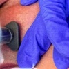 Image 1: Up to 65% Off on Micro-Needling at Aero Laser and Skin