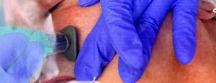 Up to 74% Off on Micro-Needling at Aero Laser and Skin