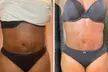 Up to 50% Off on Lipo - Non-Invasive Laser-iLipo at Extreme body sculpting - Second Medium