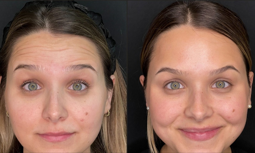 Image 2: Forehead Line Softening & 1ml Lip Enhancement for a Radiant Look