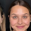 Image 2: Forehead Line Softening & 1ml Lip Enhancement for a Radiant Look