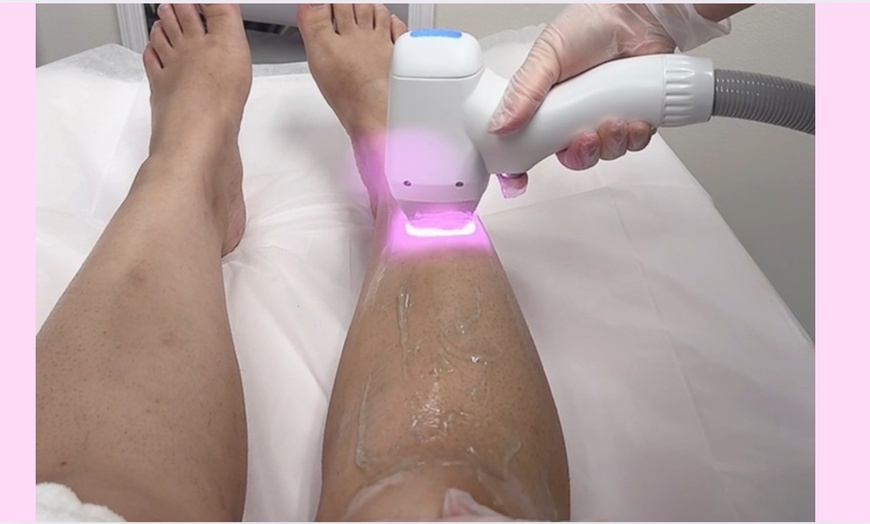 Image 2: Up to 50% Off on Laser Hair Removal at Sara Aesthetics LLC