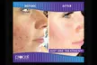 Rejuvenate with Procell Therapies: Face & Neck or Stretch Marks & More (Up to 37% Off) at Nouveau Toi Med Spa - Second Medium