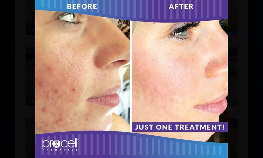 Image 5: Rejuvenate: Procell Therapies: Face & Neck or Stretch Marks & More