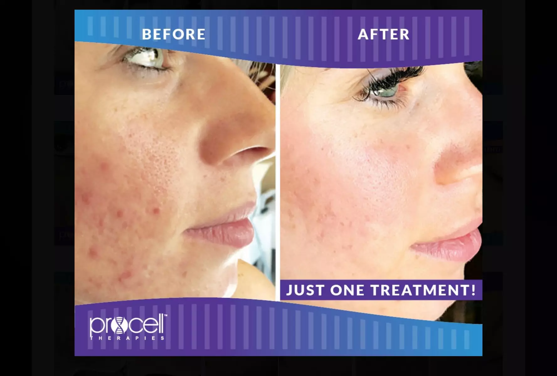 Rejuvenate: Procell Therapies: Face & Neck or Stretch Marks & More