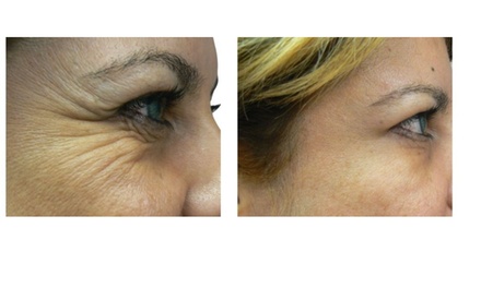 Xeomin For Depressor Angulis Oris Muscle ( DAO) - Rafael Diaz-Yoserev, MD., FACS