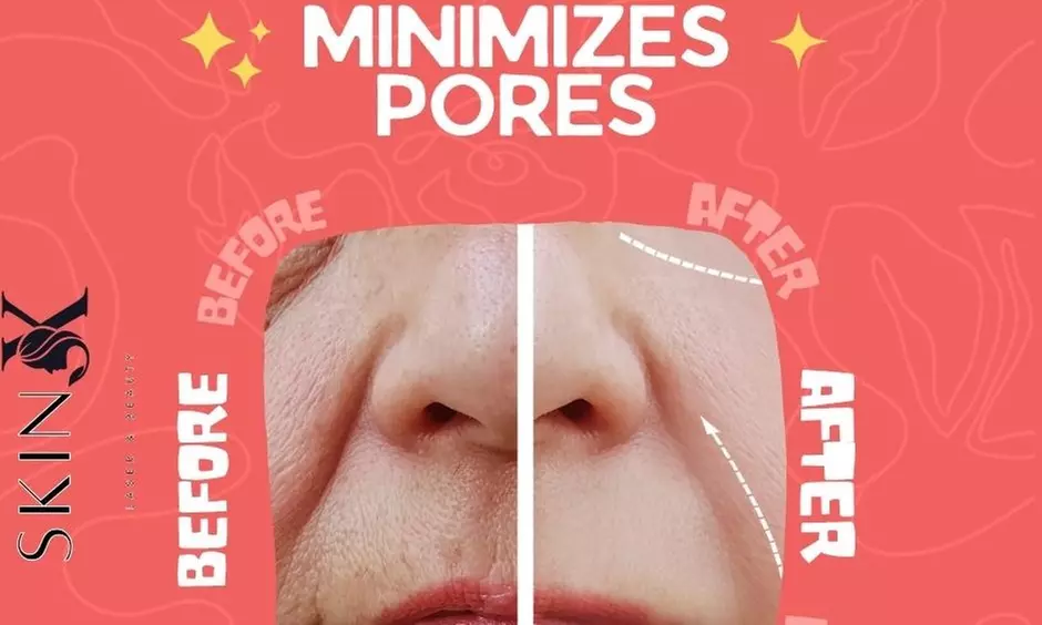 Revitalize Your Skin with One or Two Micro-Needling Treatments