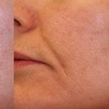Image 1: Transform Your Skin with Laser Genesis Session at Vascular Cosmetics