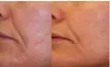 Transform Your Skin with Laser Genesis Session or IPL Treatment at Vascular Cosmetics - Up to 50% Off