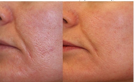 One session of Laser Genesis - Vascular Cosmetics