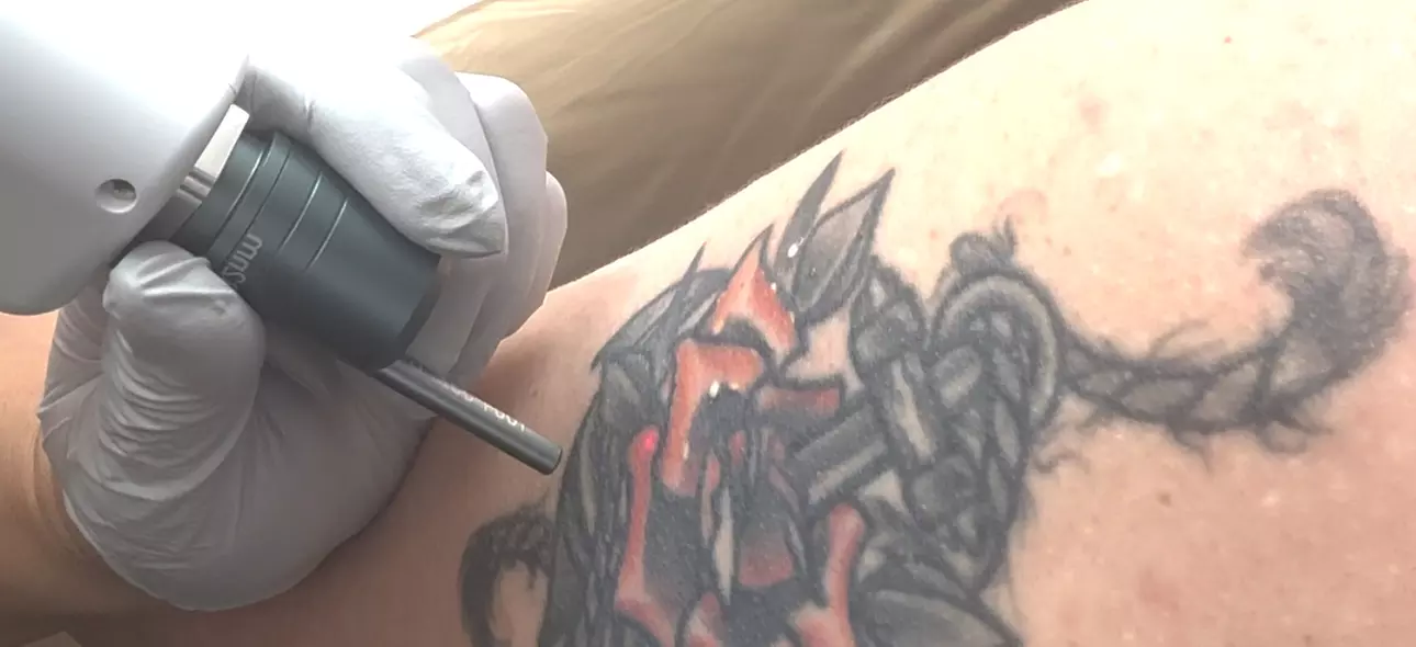 Up to 55% Off on Tattoo Removal at The Body Lux