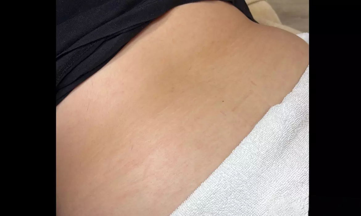 One or Three Stretch Mark Removal 2x2, 4x4, 8x8 or 10x10 Session at Laser By Nicole Boca Raton (Up to 43% Off) - Second Medium