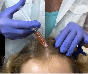 One PRP Hair Restoration Treatment - EuroPro Health