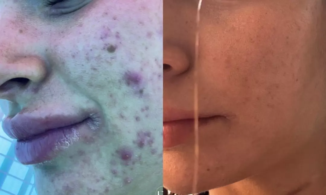 Up to 42% Off on Facial at Everly Happy