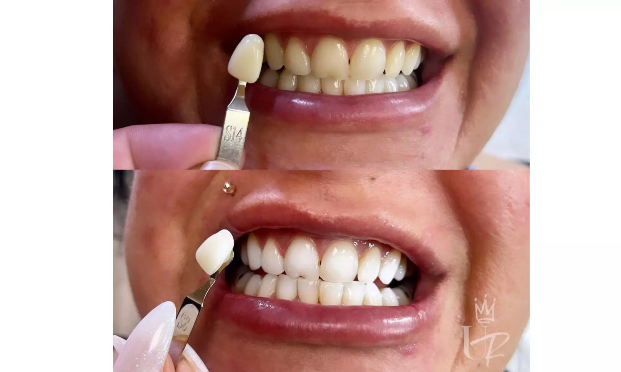 Experience UR Beauty's Teeth Whitening: Brighten in 30- or 60-Minute (Up to 56% Off) - Second Medium