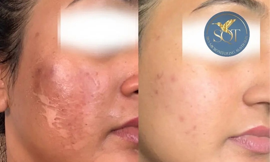 Image 3: Up to 40% off Liquid Microneedling Treatment at Exotica Skin Care