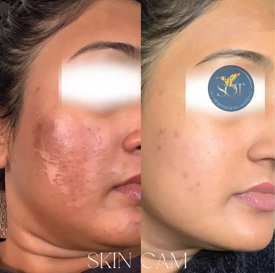 Up to 40% off Liquid Microneedling Treatment at Exotica Skin Care