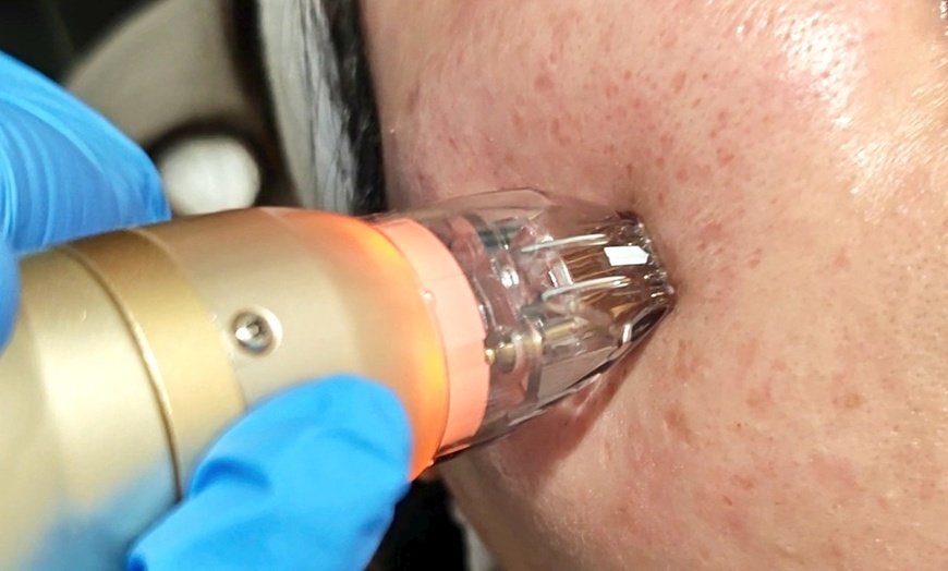 Image 8: Reverse Ageing & Repair Scars: Sylfirm X (One, Two, or Three Sessions)
