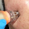 Image 8: Reverse Ageing & Repair Scars: Sylfirm X (One, Two, or Three Sessions)