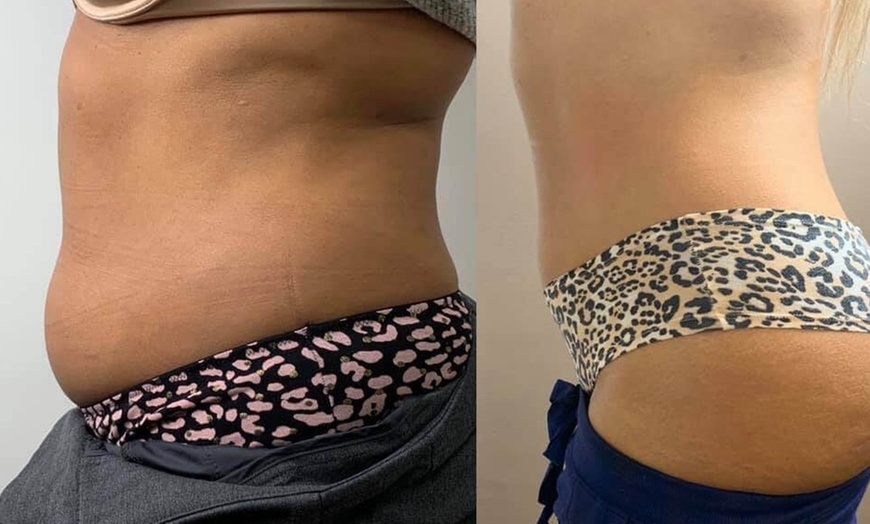 Image 4: Up to 60% Off on Cryolipolysis / Fat Freezing at Miso Life