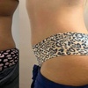 Image 4: Up to 60% Off on Cryolipolysis / Fat Freezing at Miso Life