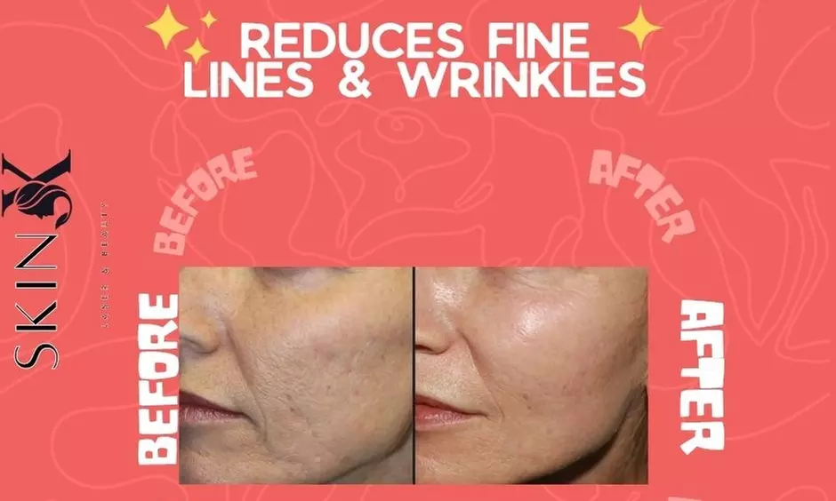 Revitalize Your Skin with One or Two Micro-Needling Treatments