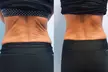 Non-Surgical Solution: Fix Stubborn Fat with Lipo Sculpt Lite - Second Medium