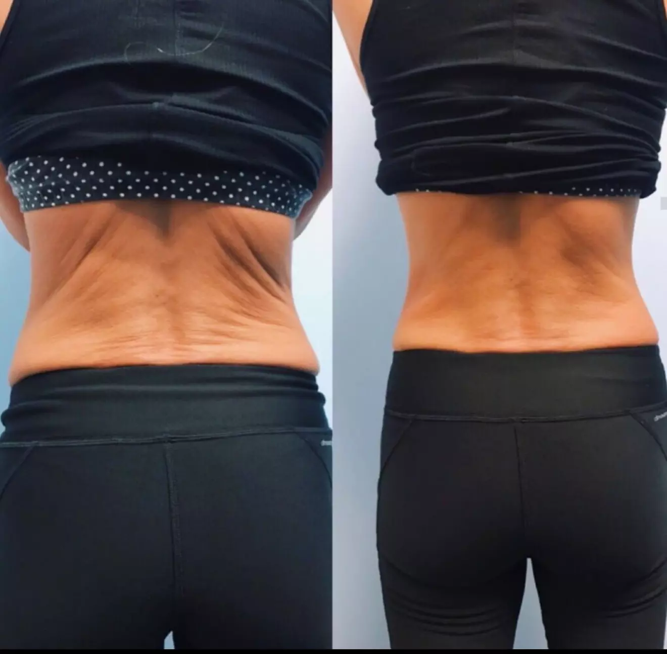 Non-Surgical Solution: Fix Stubborn Fat with Lipo Sculpt Lite