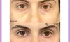 Half Syringe or 1ml RHA Dermal Filler for a Youthful Look at ArtfulSurgery (Up to 35% Off)